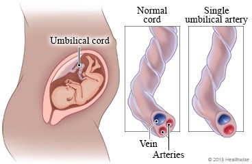 Featured image of post 2 Vessel Umbilical Cord Complications