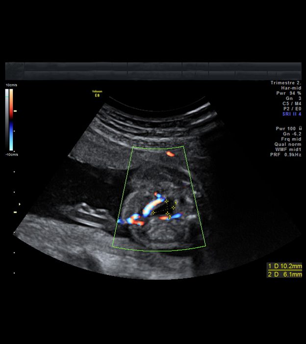 pics 2 Vessel Umbilical Cord Complications