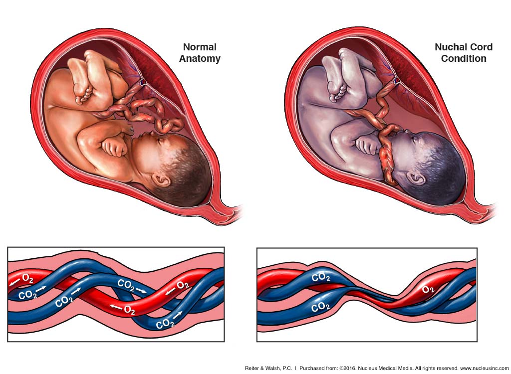 wallpapers 2 Vessel Umbilical Cord Complications