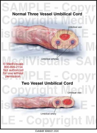 photo 2 Vessel Umbilical Cord Complications