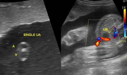 pics 2 Vessel Umbilical Cord Complications