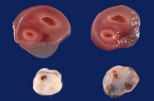 pic 2 Vessel Umbilical Cord Significance