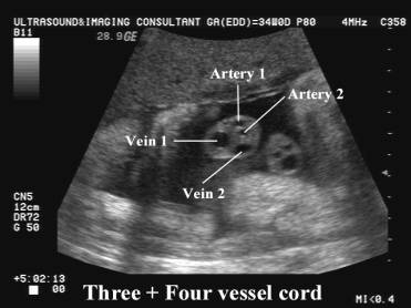 pic 2 Vessel Umbilical Cord Significance