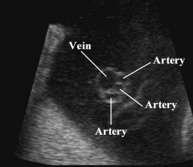 picture 2 Vessel Umbilical Cord Significance