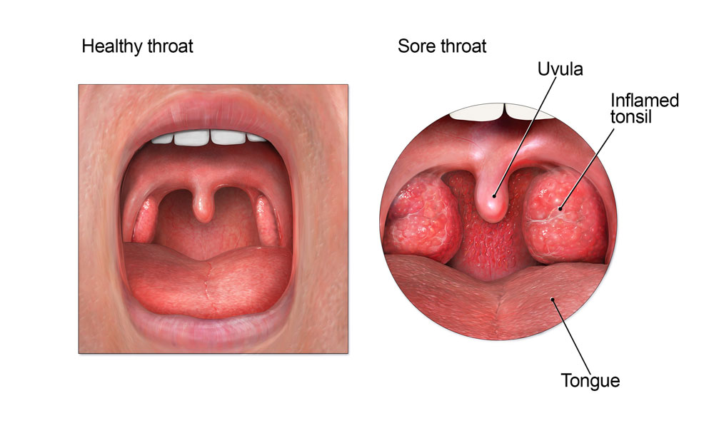 photo Sore Throat Images Symptoms