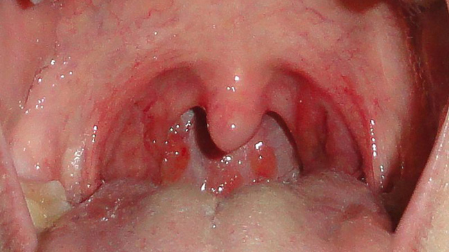 pic Sore Throat Images Symptoms