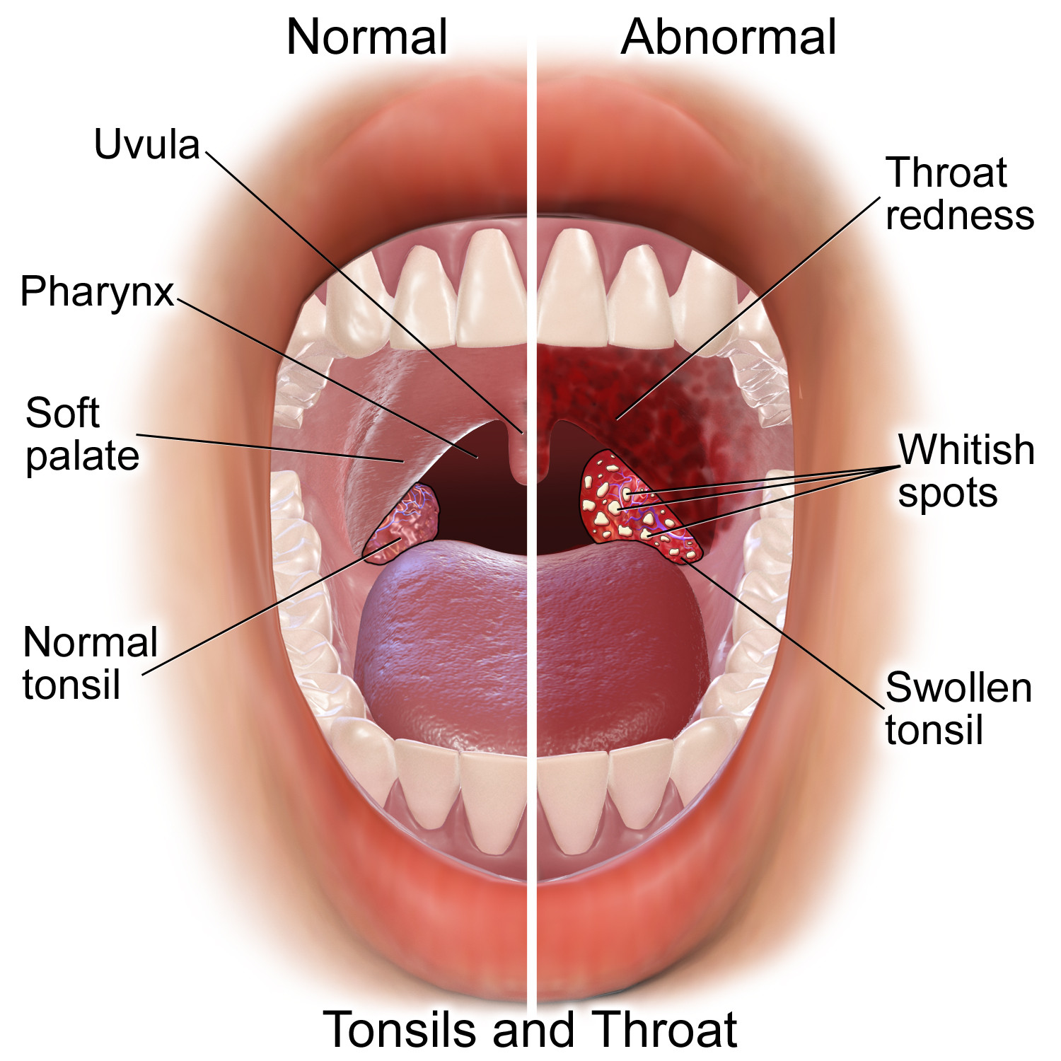 wallpapers Sore Throat Images Symptoms