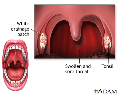 wallpapers Sore Throat Images Symptoms