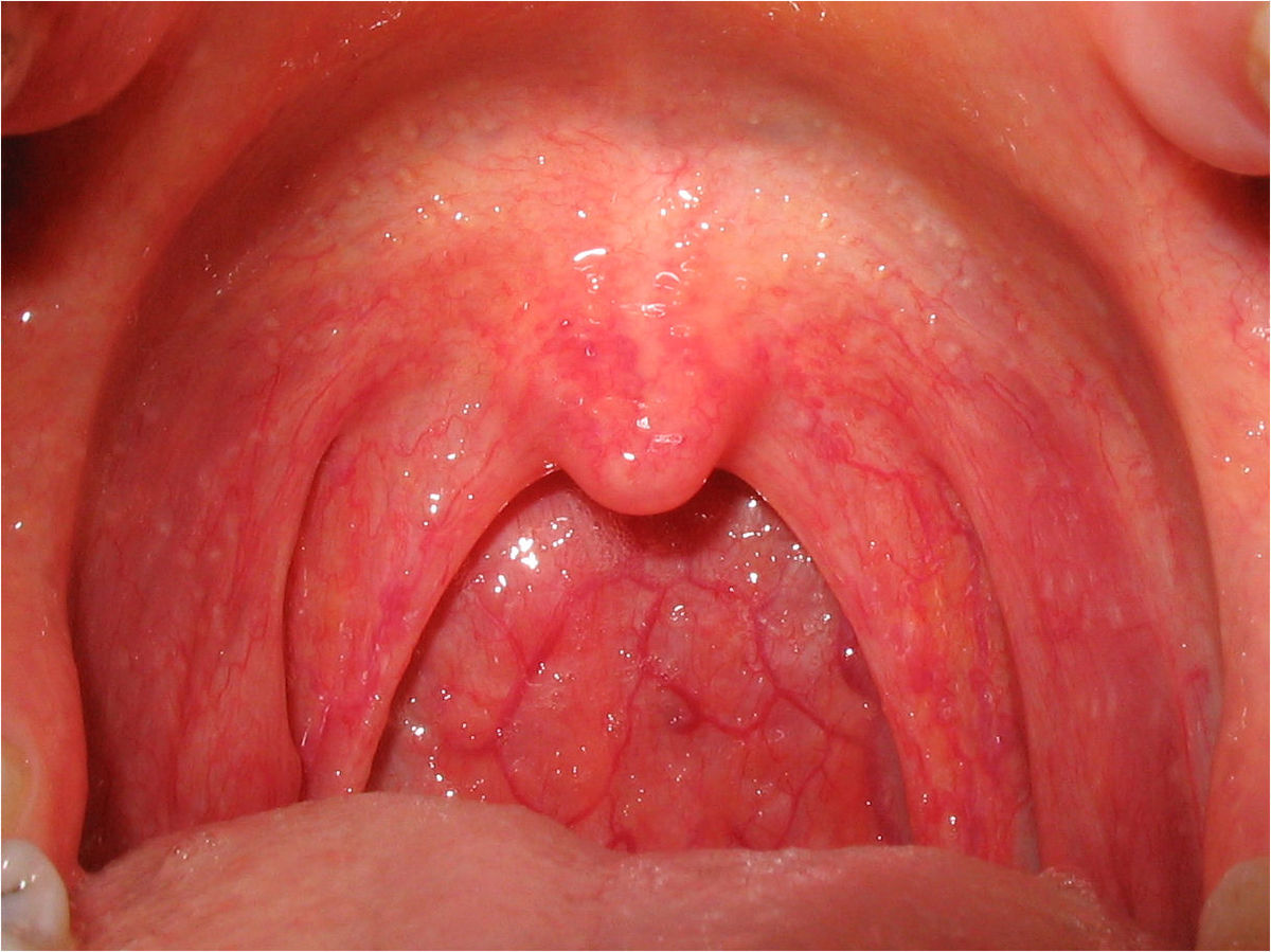 pic Sore Throat Images Symptoms