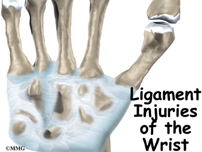 photo Torn Ligament In Wrist Pictures